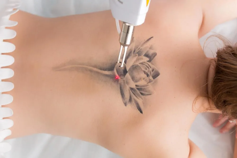 Détatouage à Bruxelles, KR Beauty Studio