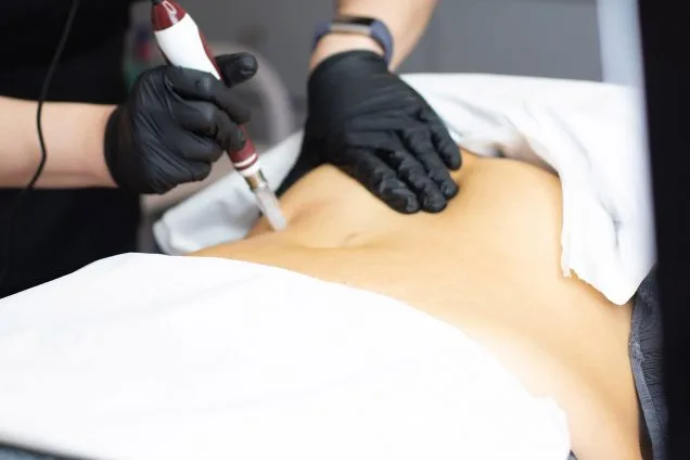 Microneedling à Bruxelles, KR Beauty Studio