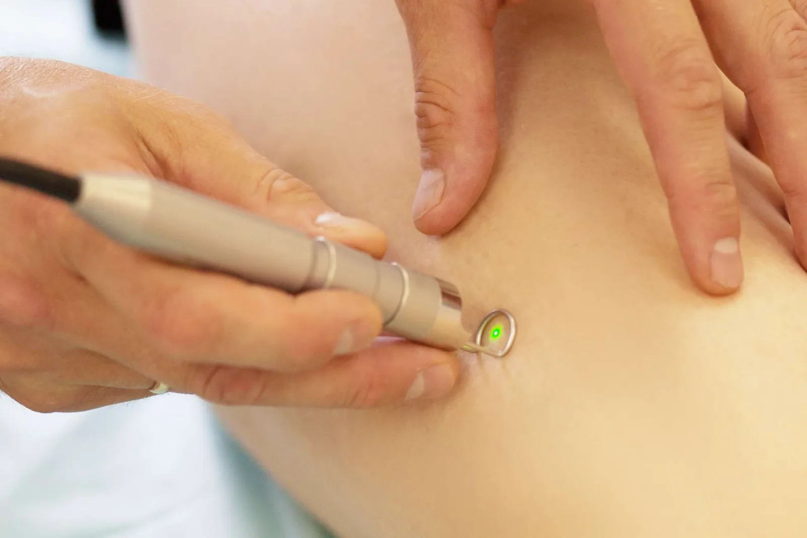 Laser Vasculaire à Bruxelles, KR Beauty Studio