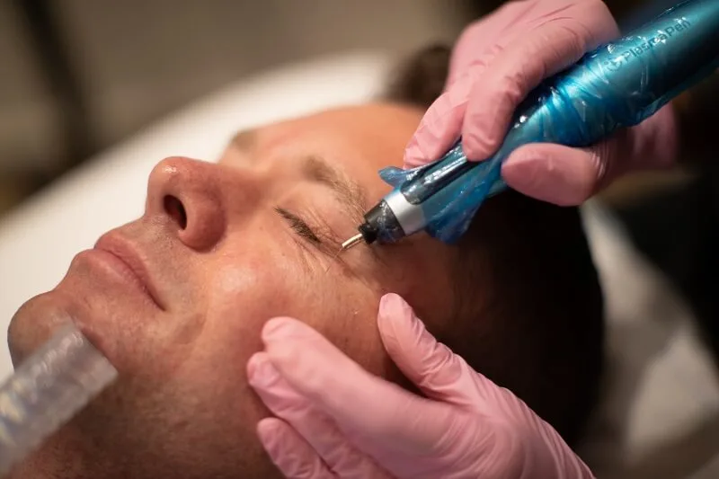 Le Plasma Pen à Bruxelles, KR Beauty Studio