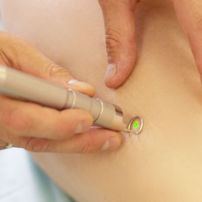 laser-vasculaire